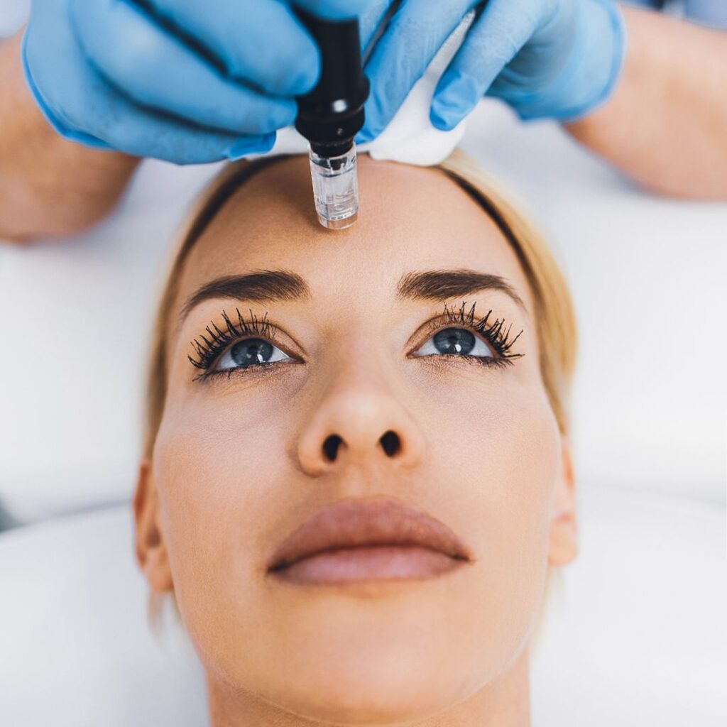 Woman receiving professional microneedling treatment to rejuvenate skin and improve texture.