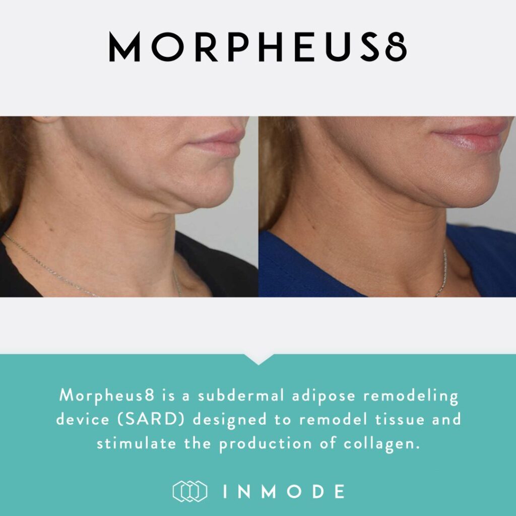 Morpheus8 Before and After Neck