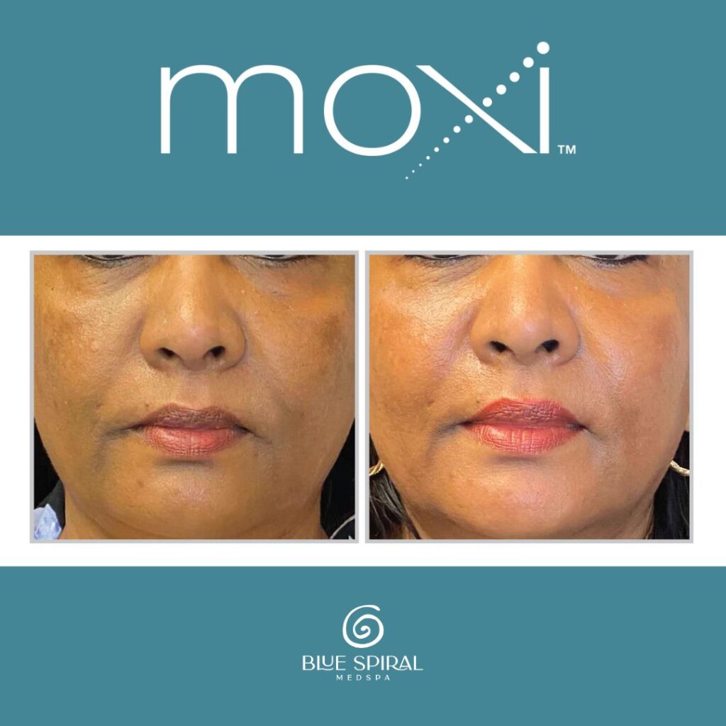 Moxi Laser Skin Rejuvenation Before and After 1