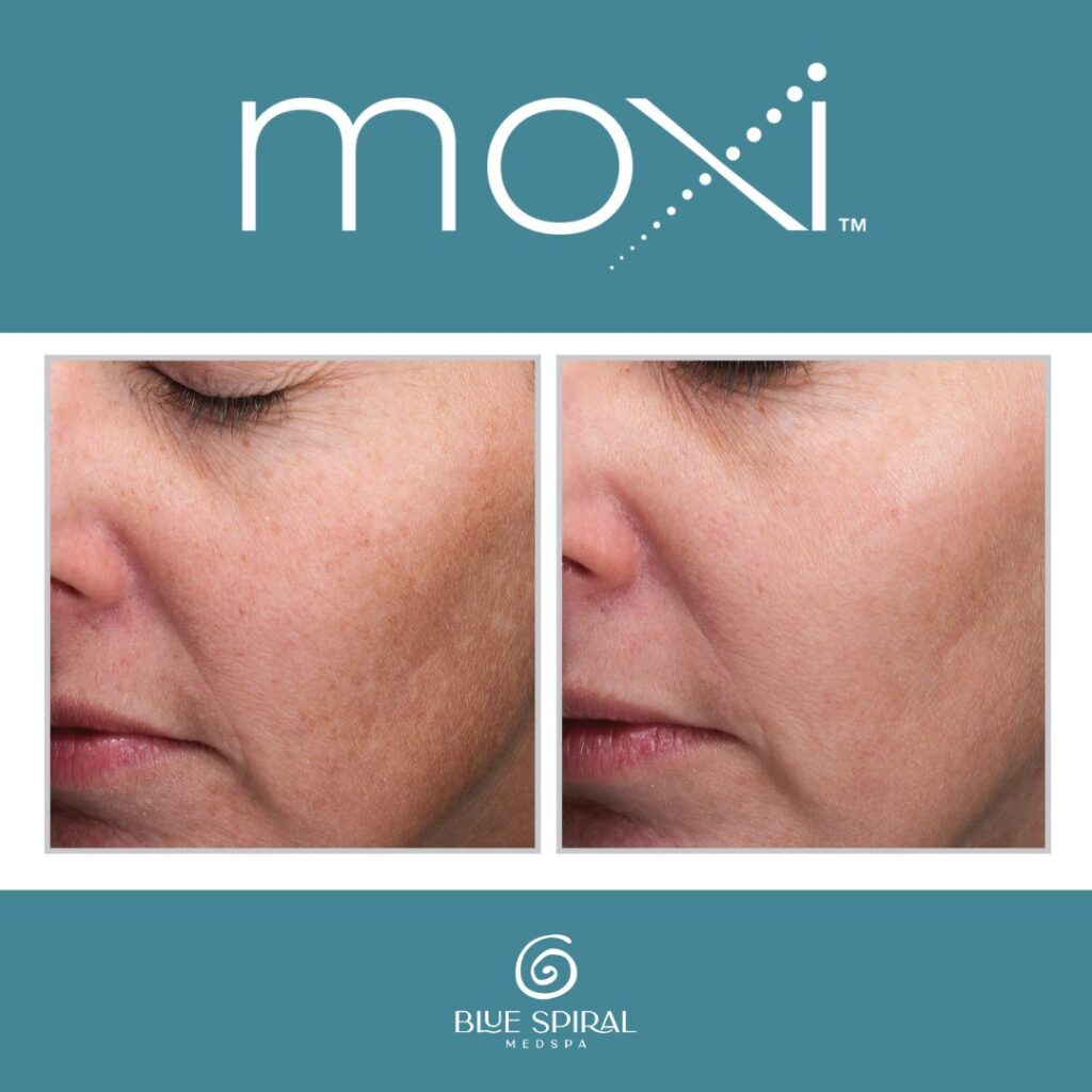 Moxi Laser Skin Rejuvenation Before and After 2