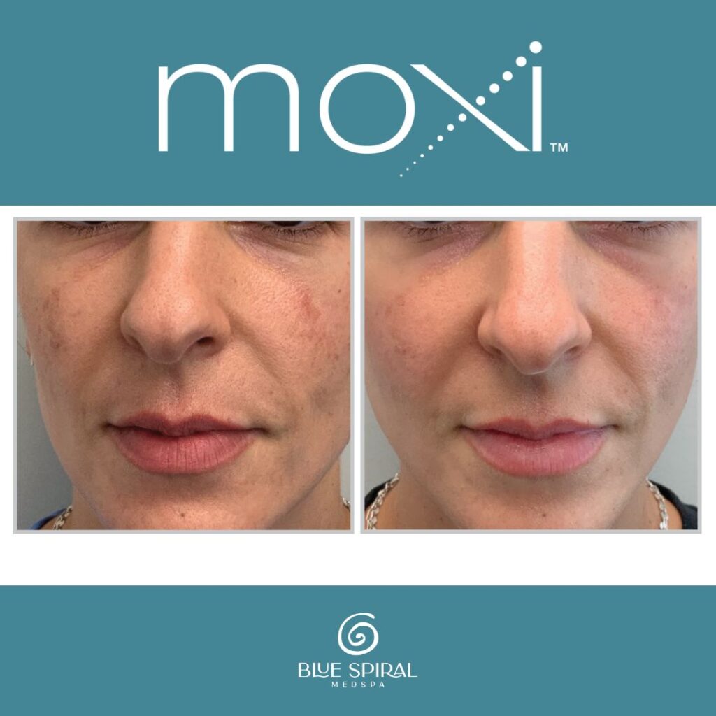 Moxi Laser Skin Rejuvenation Before and After 3