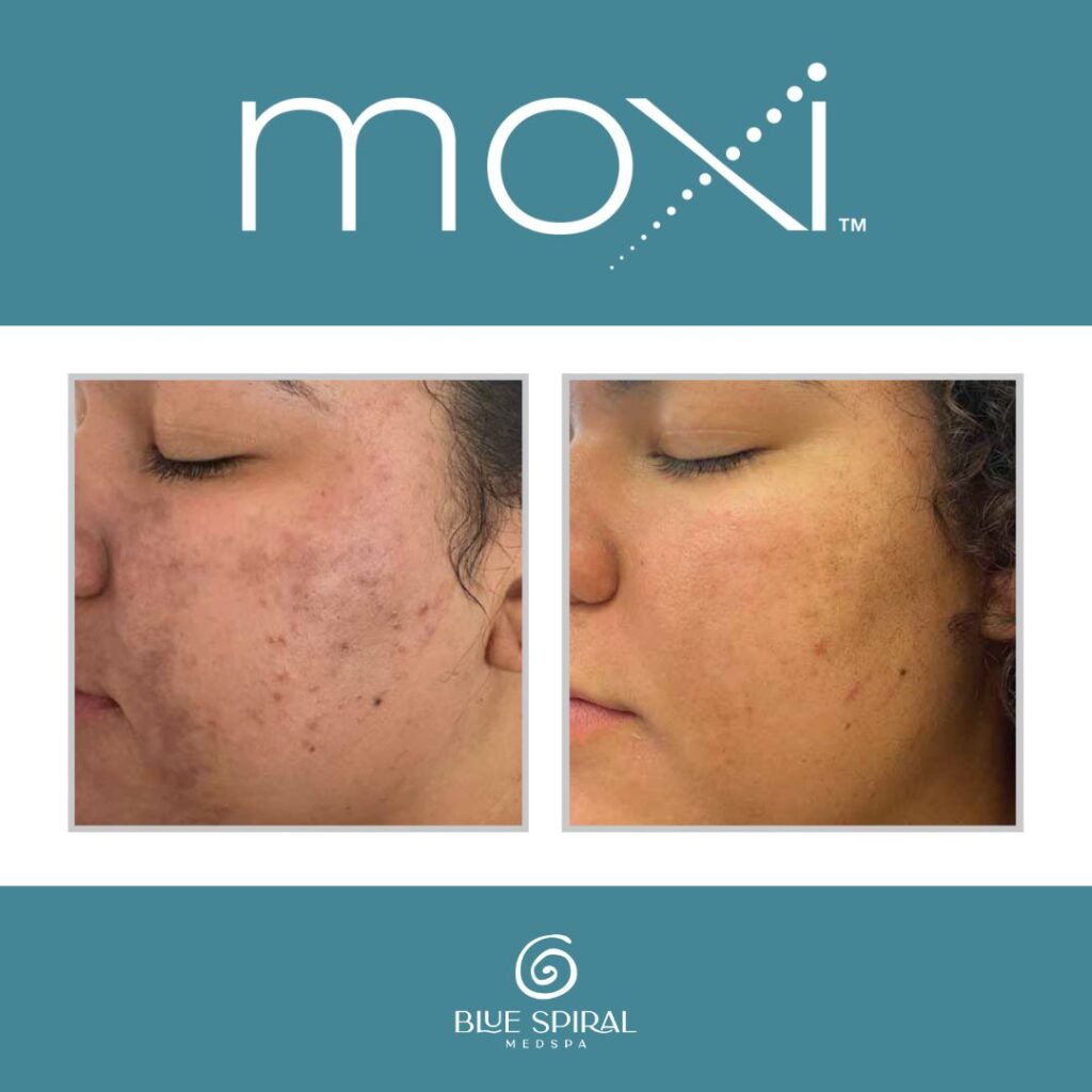 Moxi Laser Skin Rejuvenation Before and After 4
