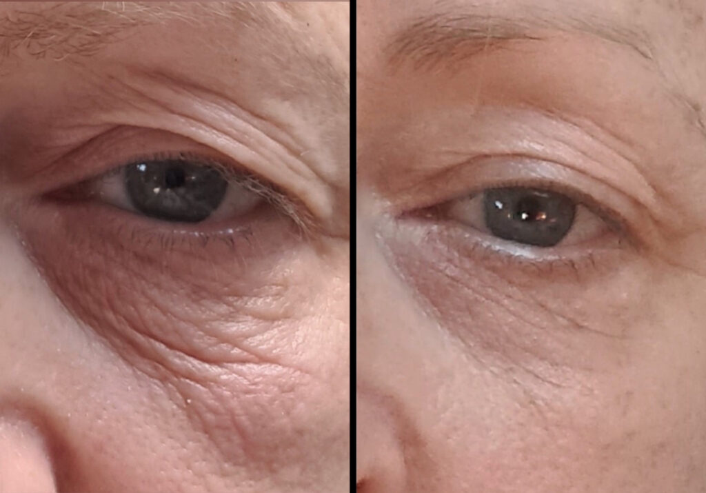 Sofwave before and after photo of a womens eyes