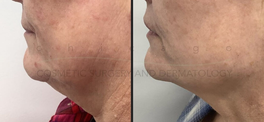 Sofwave before and after photo of a womens chin