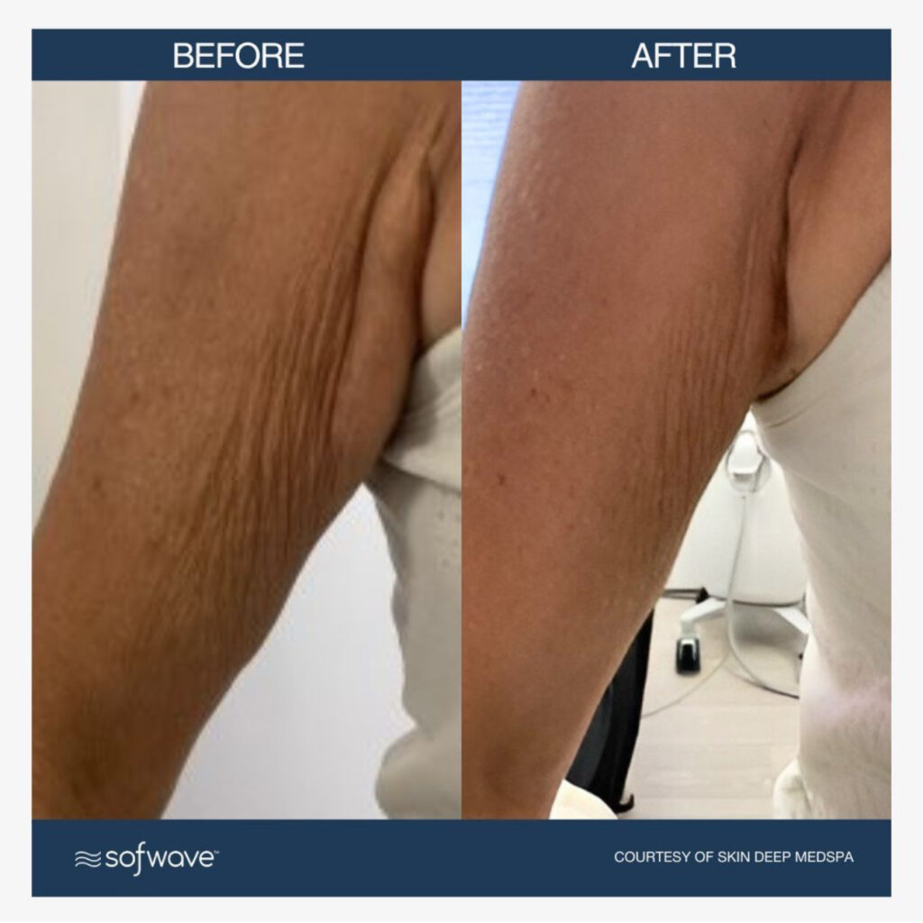 Sofwave before and after photo of a womens arms