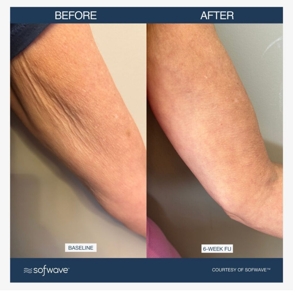 Sofwave before and after photo of a womens arms