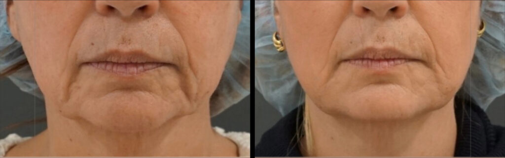 Sofwave before and after photo of a womens cheeks