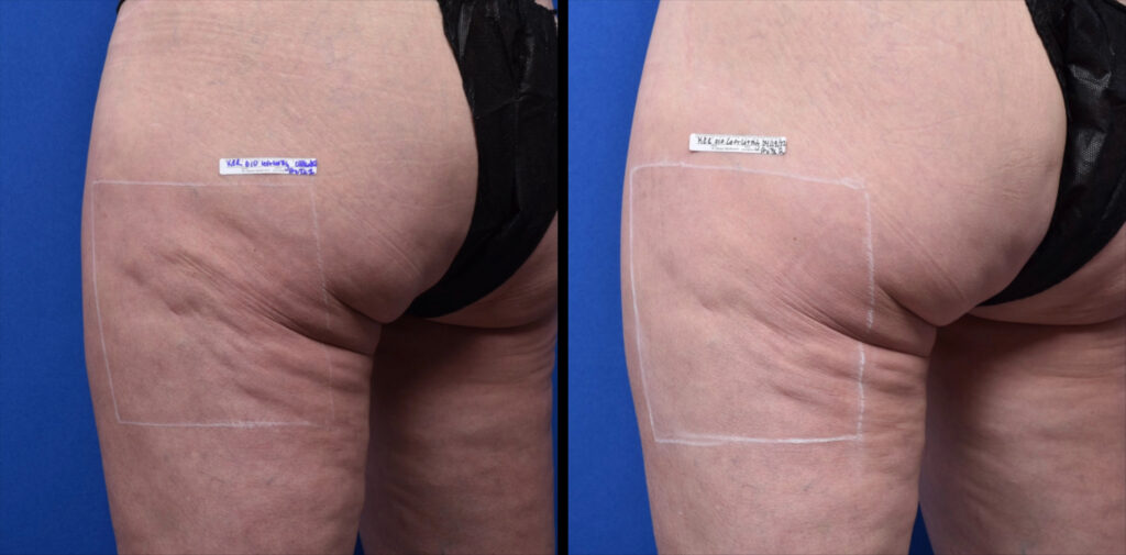 Sofwave before and after photo of a womens buttocks