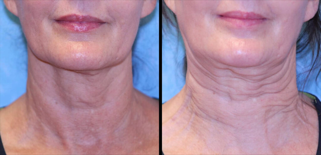 Sofwave before and after photo of a womens neck